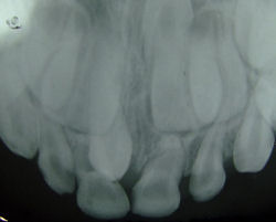 Two supernumerary teeth at premaxilla