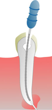 Root Canal procedure: unhealthy tooth, drilling, filing, rubber filling.