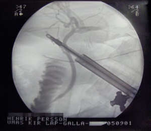 X-ray taken during a laprasopic cholecystectomy